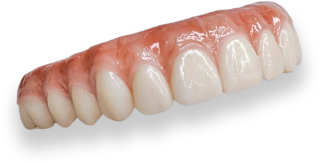 Cosmetic dental veneers