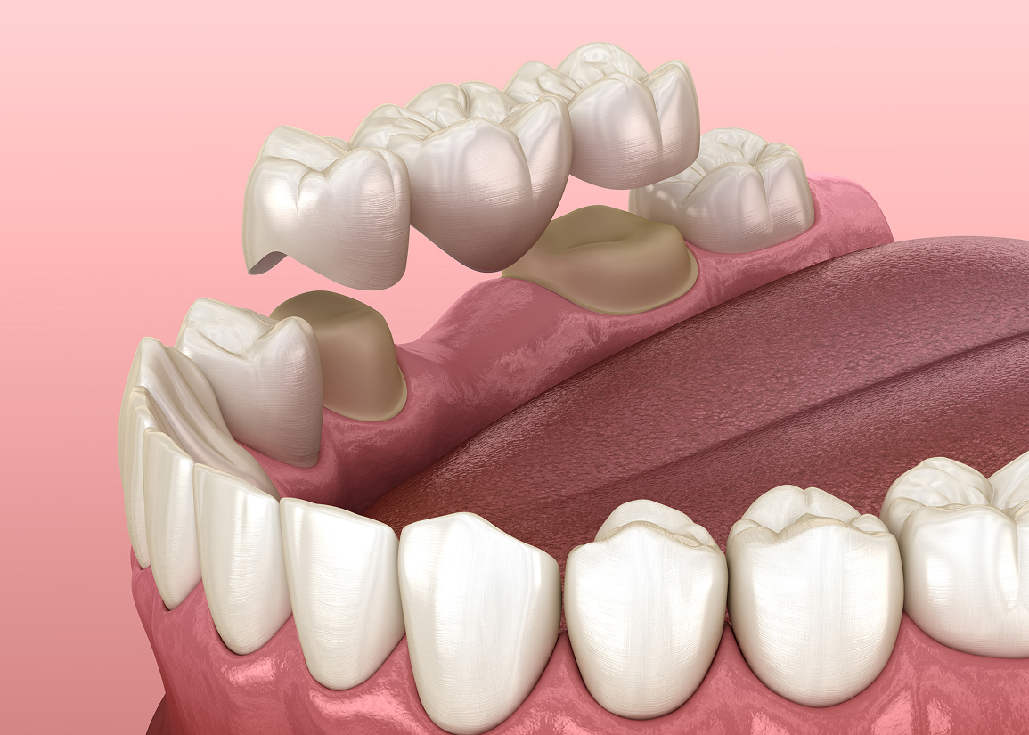 Dental bridge tooth replacement at Press and Berman Clifton NJ