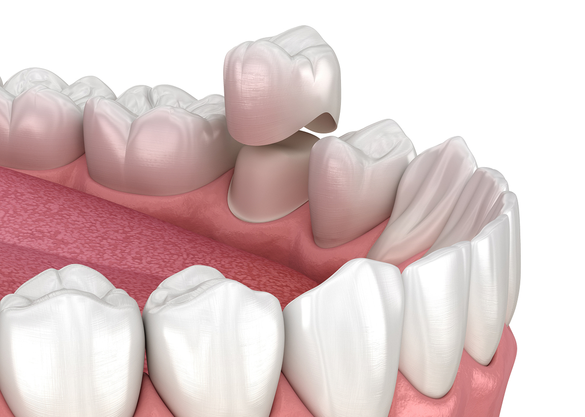 Dental crown restoration at Press and Berman Clifton NJ