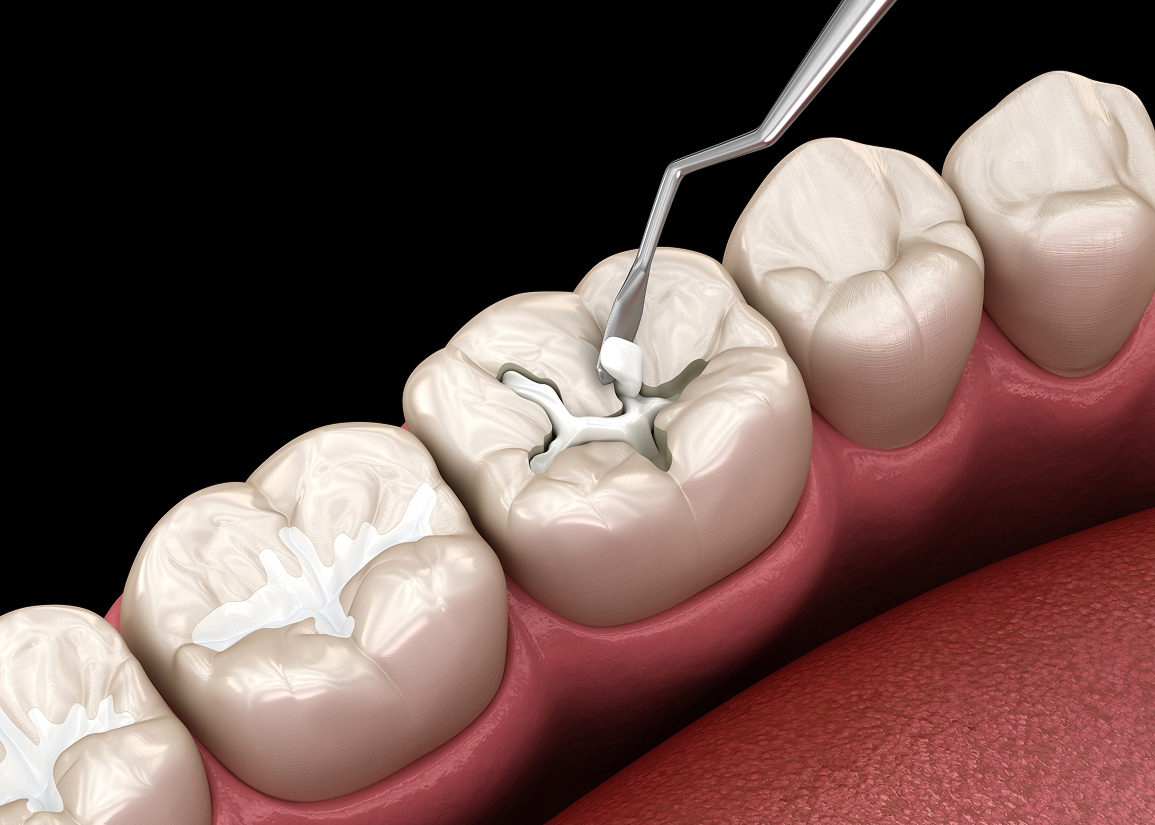 Dental filling treatment for cavities in Clifton NJ