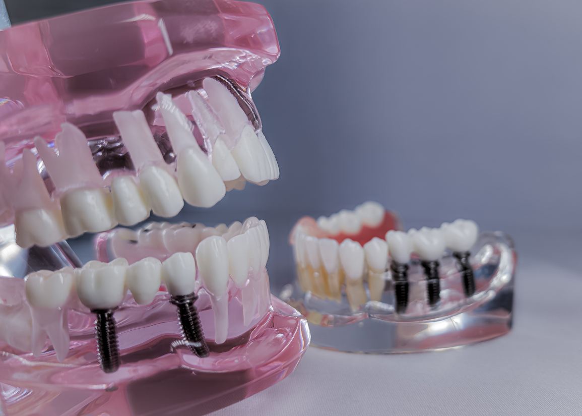 Dental implants tooth replacement in Clifton NJ
