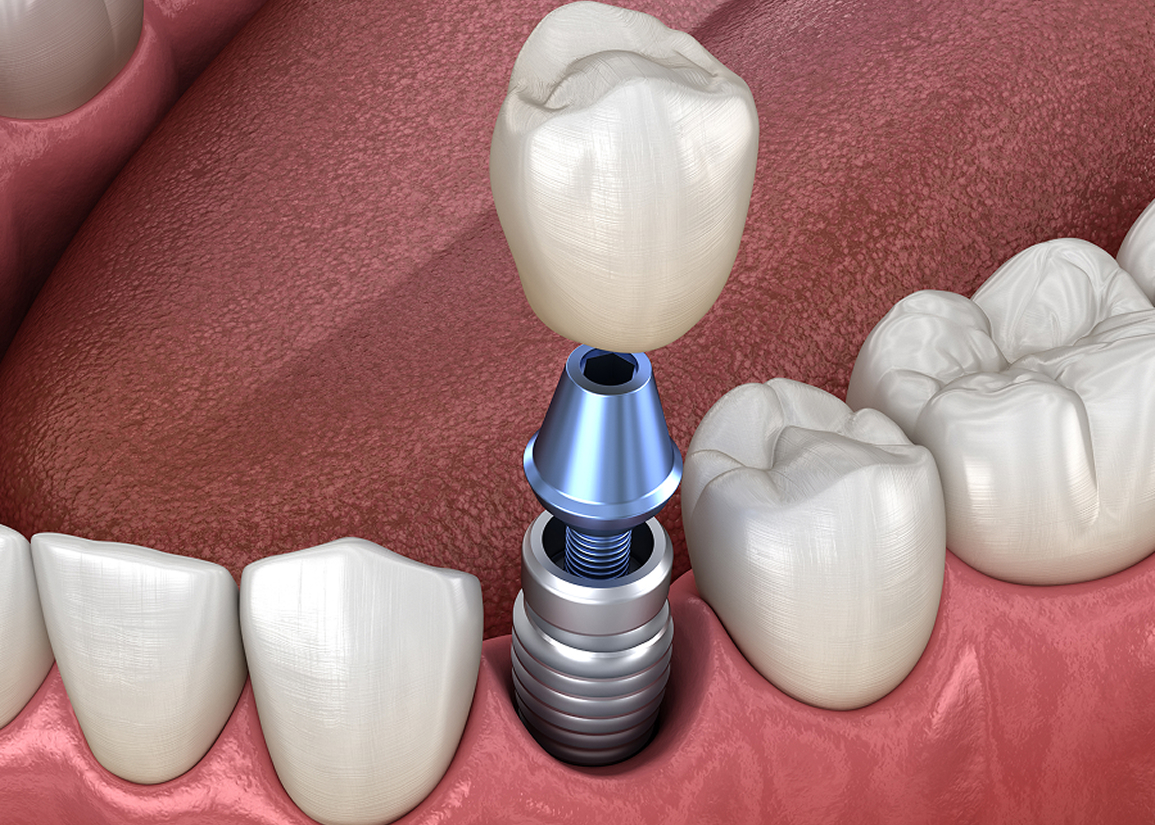 Dental implant candidacy evaluation at Press and Berman