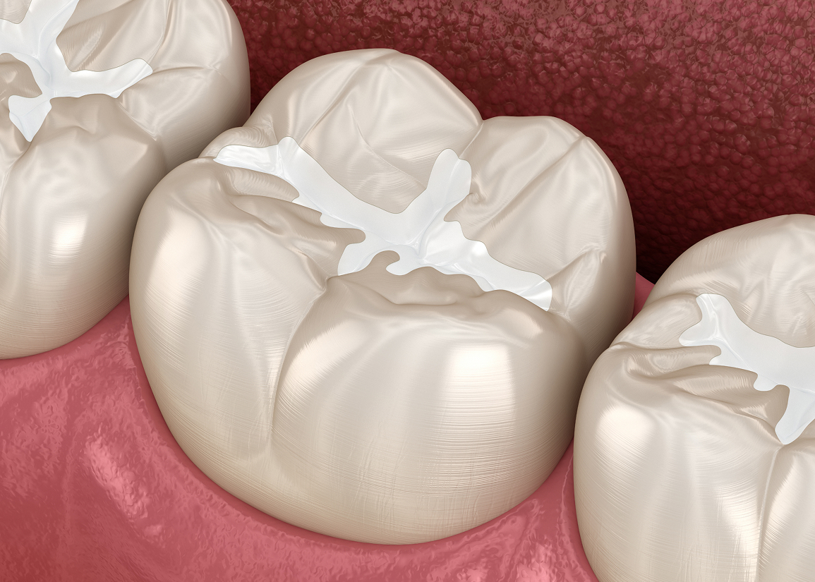 Dental sealant protective coating on teeth