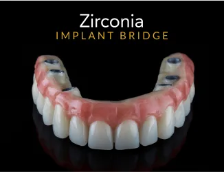 Zirconia Implant Bridge
