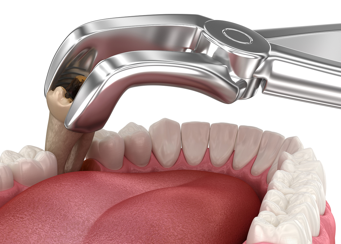 Tooth extraction at dental practice in Clifton NJ